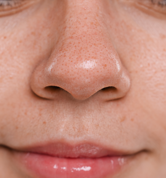 face woman with imperfections